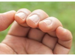 IMATE LI OVAKVE IZBOČINE NA NOKTIMA – evo šta one znače: Doktorica otkrila i možda ćete se iznenaditi