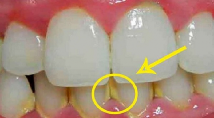 OVAJ TRIK ĆE VAM SAČUVATI I VRIJEME I NOVAC: Uklonite dentalni plak ZA SAMO 5 MINUTA, BEZ ODLASKA ZUBARU!