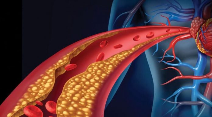 Znakovi visokog holesterola koje mnogi zanemaruju