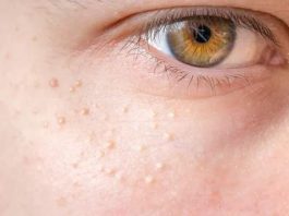 NI SLUČAJNO IH NE ISTISKUJTE, IMATE LI OVE BIJELE TAČKICE NA LICU? Uklanjaju se jednstavno, TREBAJU VAM 3 SASTOJKA KOJA IMATE U KUĆI