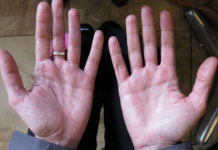 SIMPTOMI BOLESTI JETRE, uočite ih rano: 10 znakova KOJE VAM ŠALJE VAŠE TIJELO!